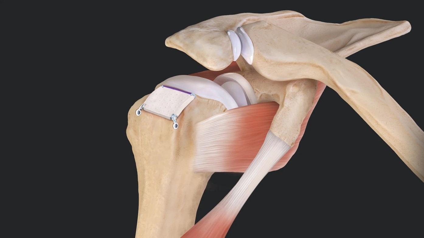 Shoulder Tuberoplasty Ease Your Impingement Pain